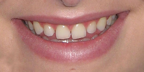 Case 1 — Porcelain Veneers — before